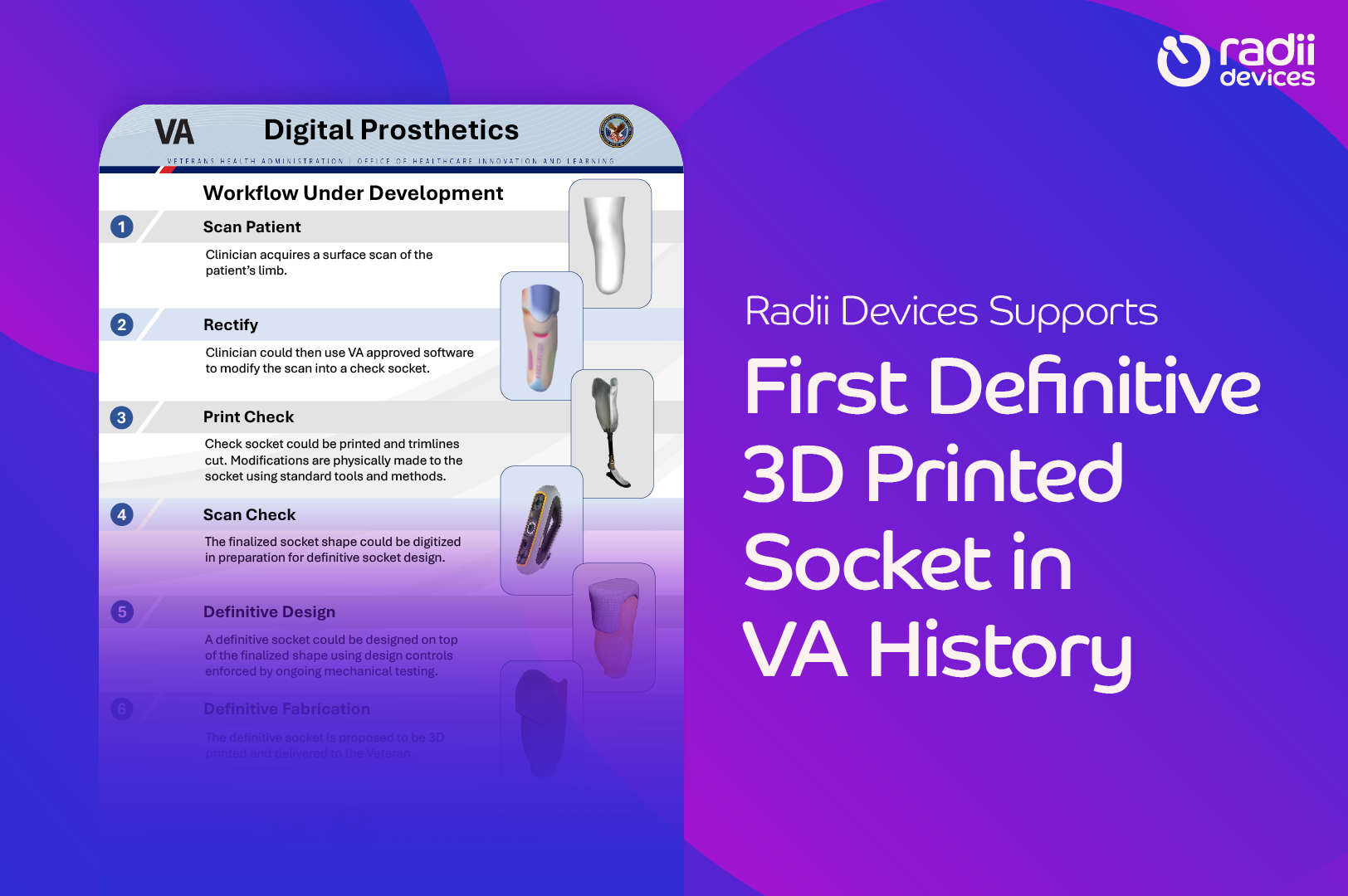 An image of a multistep plan of the VA Digital Prosthetics workflow, going from patient scan to 3d printed. Next to it, text that says "Radii Devices Supports First Definitive 3D Printed Socket in VA History".